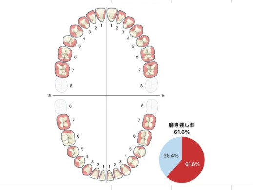 ブラッシング指導前の磨き残し（赤い部分が多い）