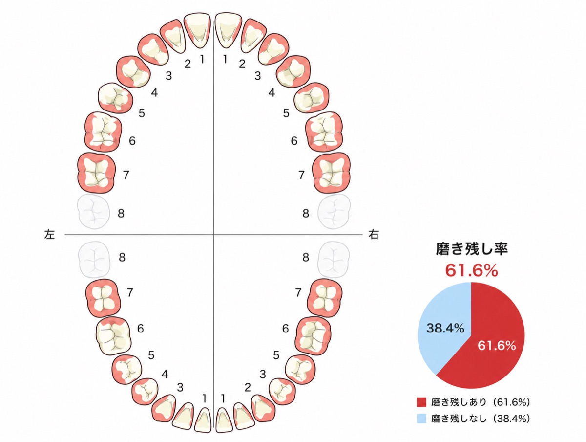 初回の磨き残し率チャート（61.6%）